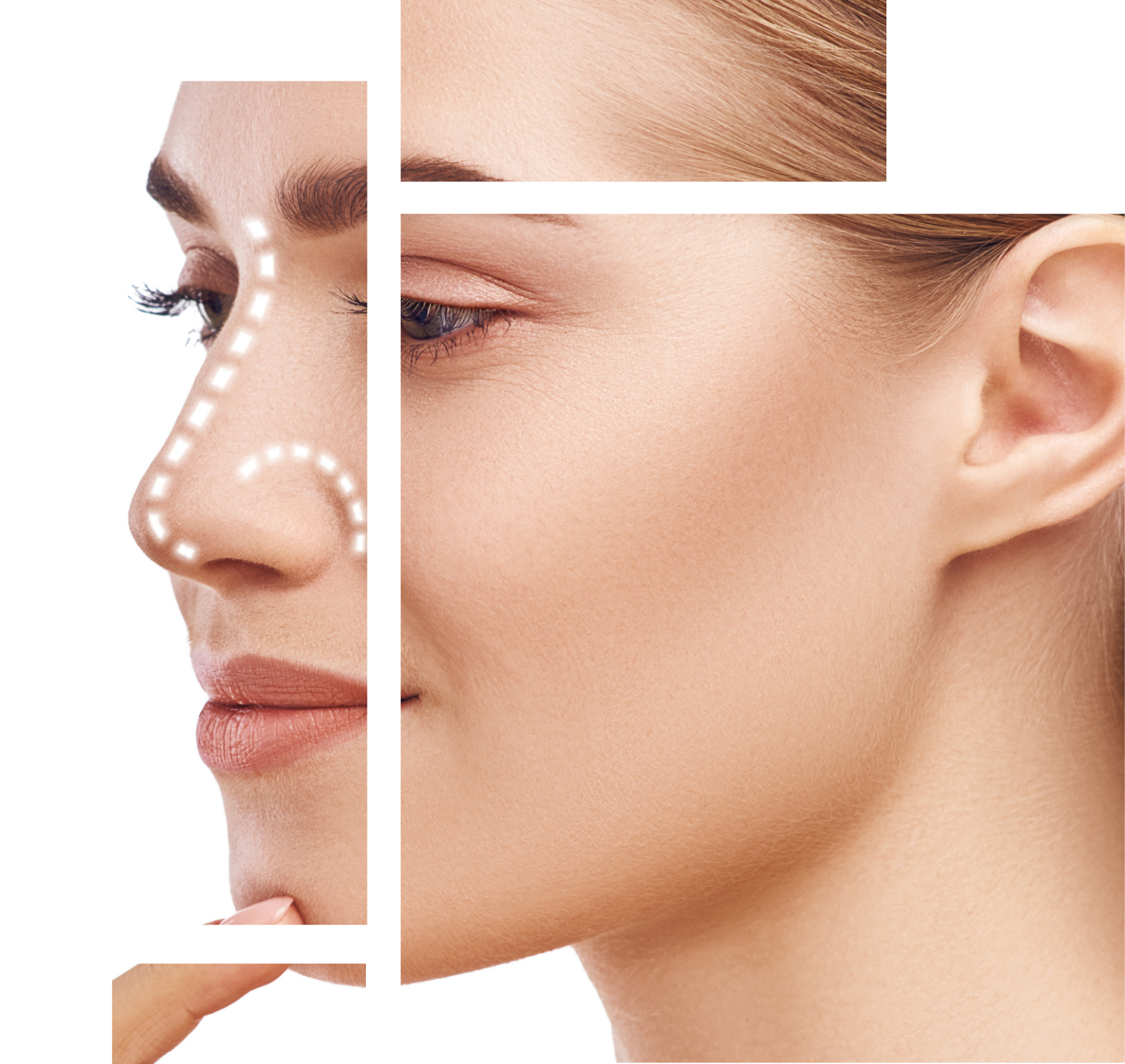 Rhinoplasty Image