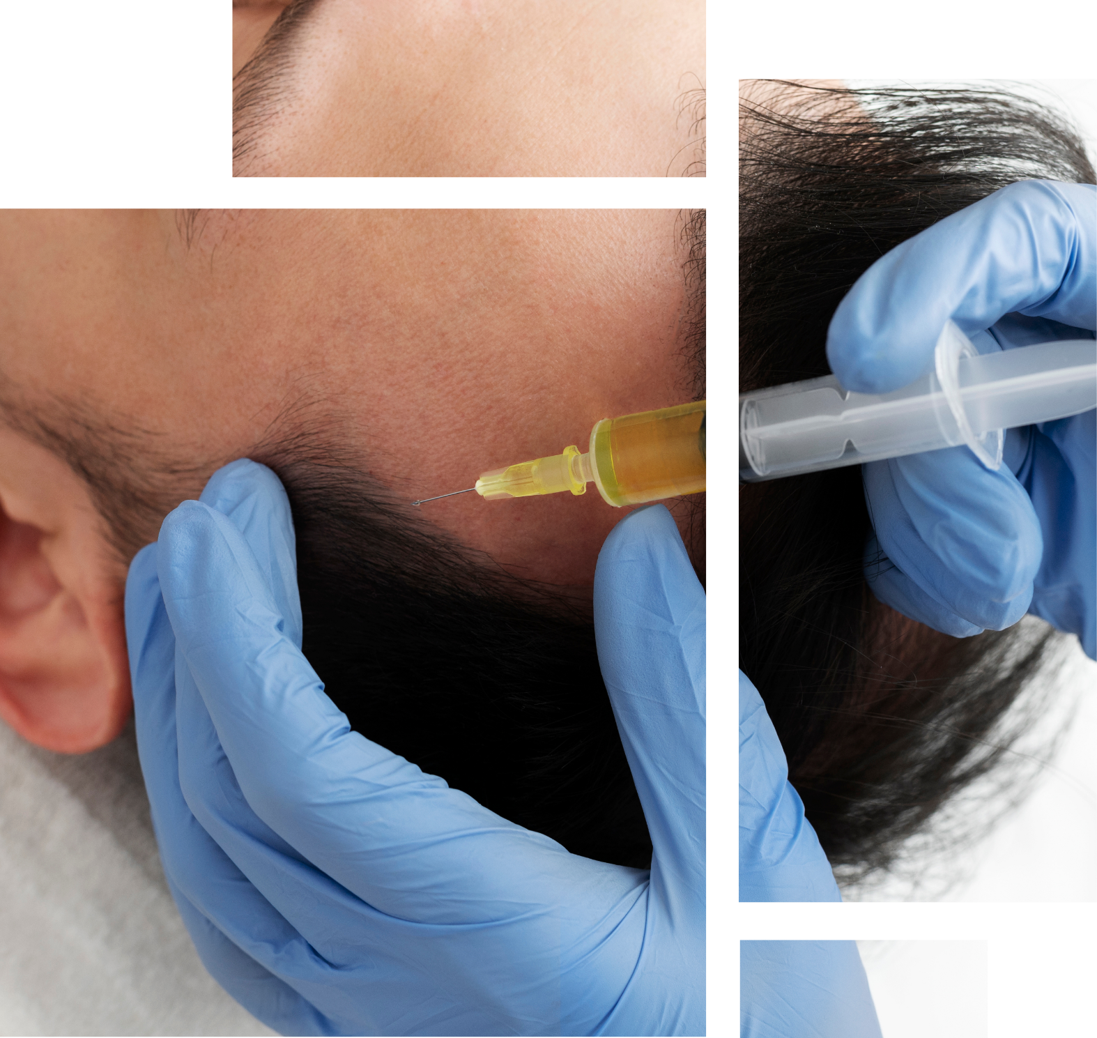 PRP for Hair Restoration