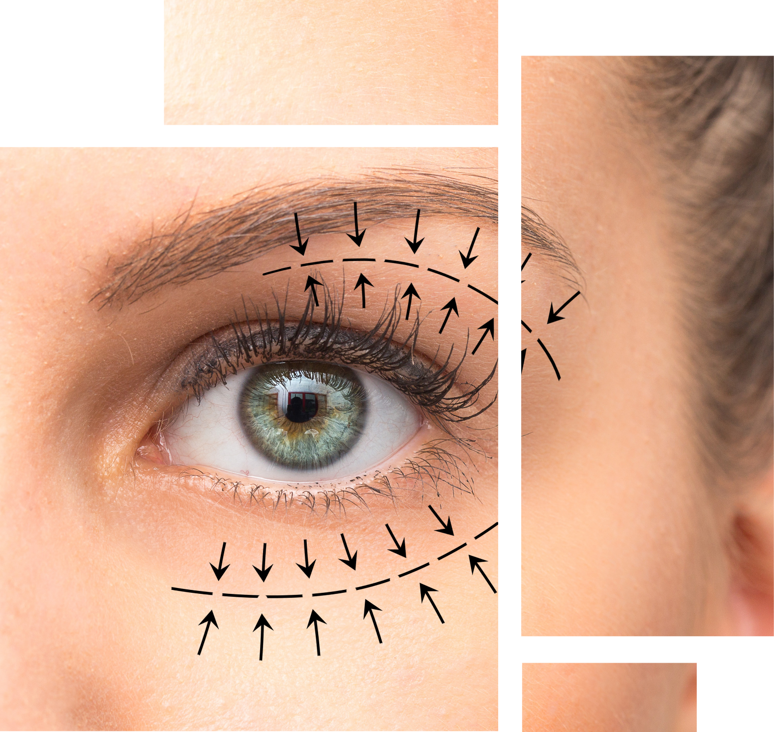 What is Eyelid or Blepharoplasty Surgery Image