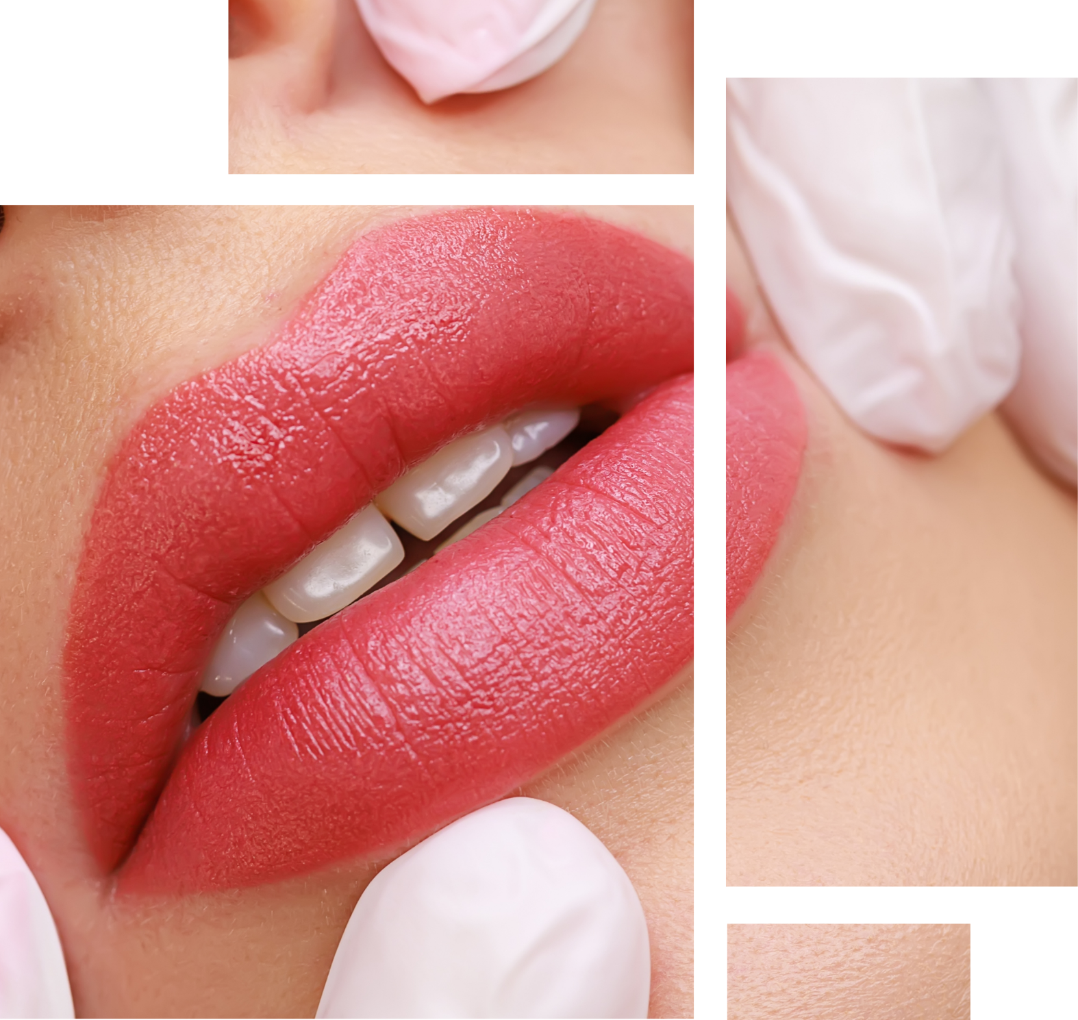 Lip Fillers Image