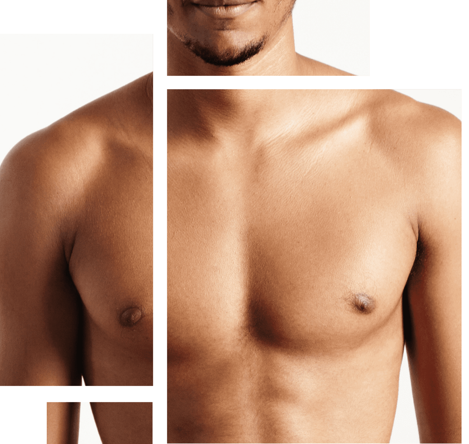 What is Gynecomastia Image