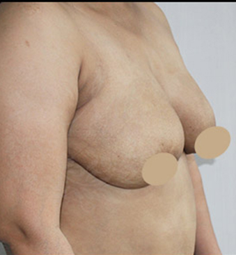 After-TransformationTuesday-Breast-Liposuction-2