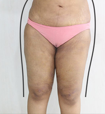 After-liposuction-thighs-done-for-contouring-1
