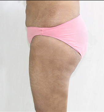 After-liposuction-thighs-to-correct-the-deformities-2