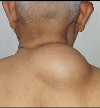 Before-tipoma-over-upper-back-1