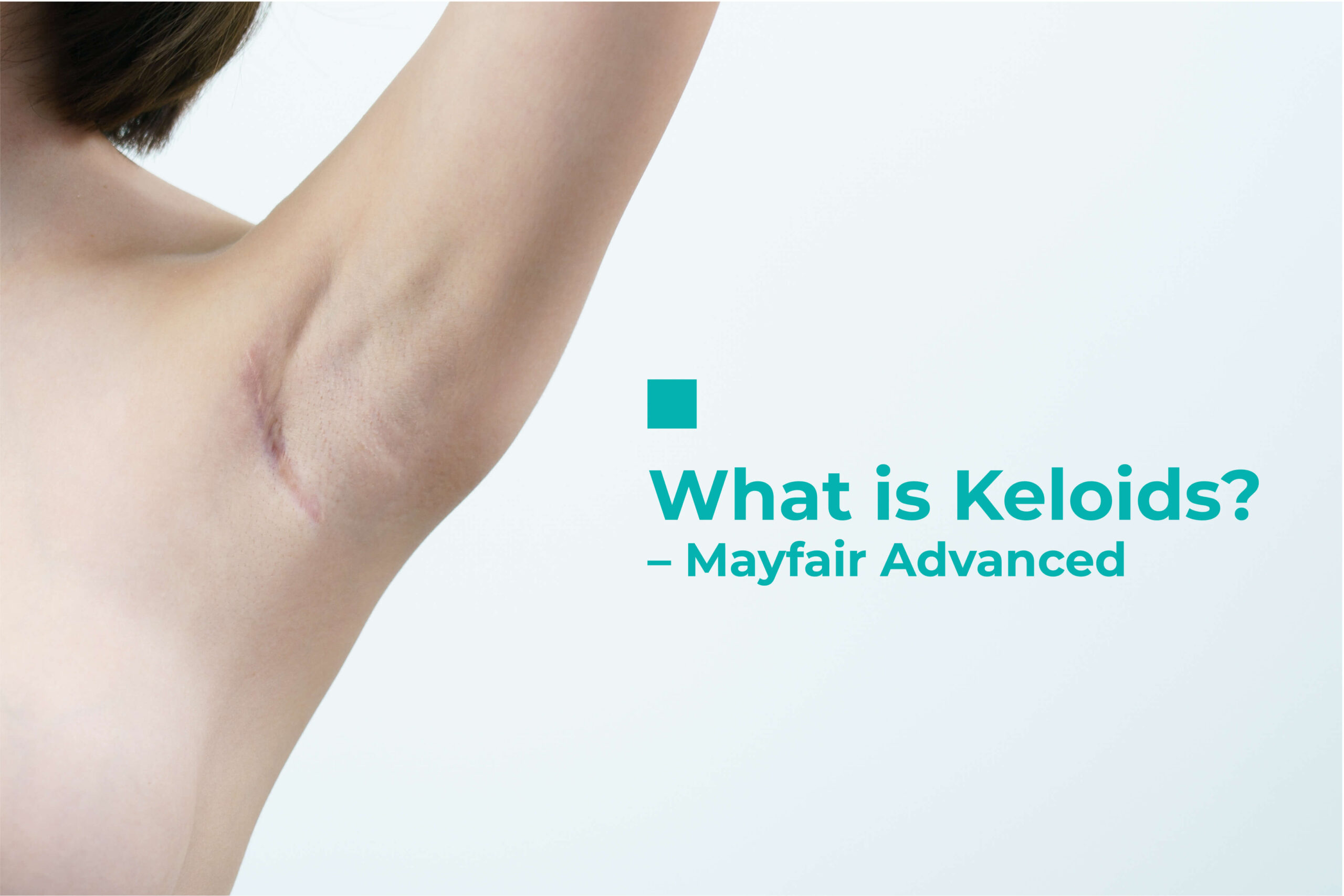 What is Keloids? – Mayfair Advanced Aesthetic