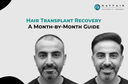 Hair Transplant Recovery. Before and after images of a man showing hair transplant recovery, with the text 'Hair Transplant Recovery: A Month-by-Month Guide' and the Mayfair Aesthetic Surgery logo.